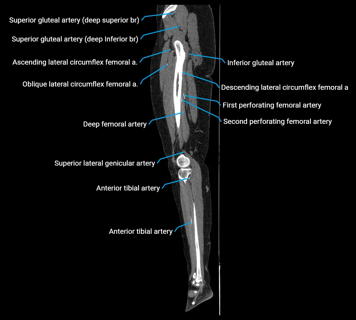 CTA lower limb sagittal cross sectional anatomy labelled image _52 (3).webp